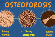 Rahasia Tulang Sehat: Cara Ampuh Melawan Osteoporosis Sejak Dini