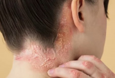 Herpes Zoster: Mengenali Gejala Cacar Ular dan Orang yang Rentan Terserang