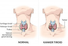 Kenali Tanda-Tanda Gangguan Tiroid Sebelum Terlambat