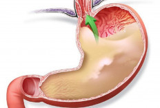 Tips Cepat Atasi GERD Kambuh: Perbaiki Posisi Tubuh dan Konsumsi Minuman Ini.