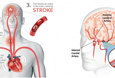 Kenali Gejala Awal Terkena Stroke: Pentingnya Deteksi Dini untuk Penanganan yang Efektif