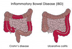 Apakah Penyakit Crohn Bisa Disembuhkan? Ini Penjelasannya