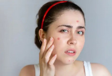 Bukan Cuma Hormonal, Ternyata Makanan Ini Bikin Jerawatan!